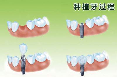 深圳種植牙要多久？