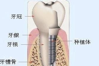 深圳種植牙危害有哪些？