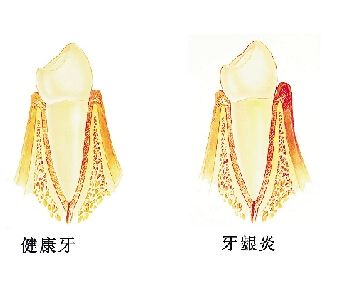 深圳怎樣治療牙齦炎？