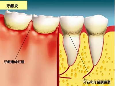 深圳孕婦牙齦炎怎么辦？