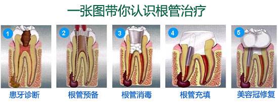 深圳做根管治療步驟有哪些？