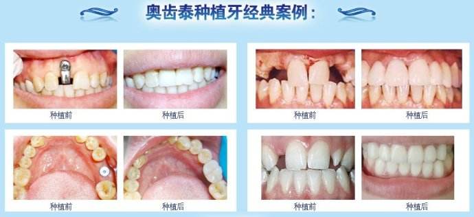 深圳奧齒泰種植牙價(jià)格是多少？