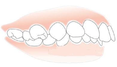 深圳牙齒有點前突怎么辦？