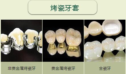 深圳烤瓷牙與全瓷牙區(qū)別