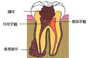 深圳孕婦牙髓炎怎么辦？