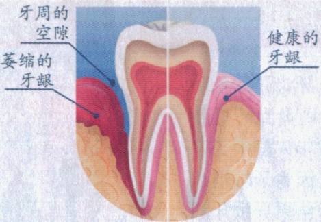 牙齦萎縮可以恢復(fù)嗎？