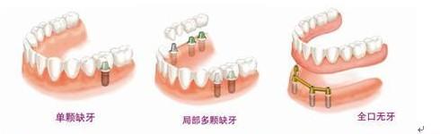 深圳種植義齒費(fèi)用