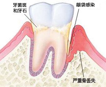 深圳牙菌斑該怎么去除？