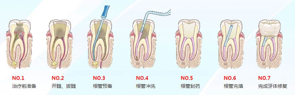 深圳牙髓炎根管治療步驟