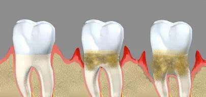 深圳牙齦萎縮怎么辦？