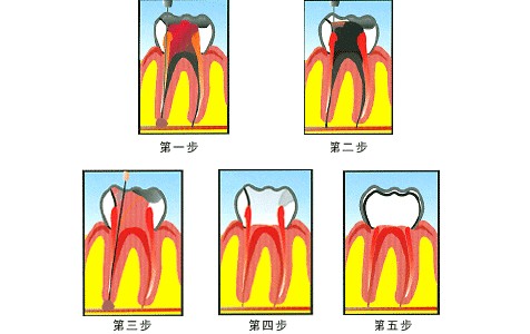 深圳牙齒做根管治療需要多少錢(qián)？