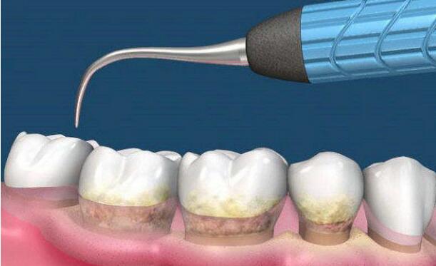 深圳怎樣才能去除牙結(jié)石？