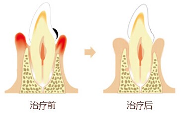 深圳怎樣治療牙周炎？