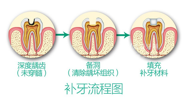 深圳兒童齲齒治療過程