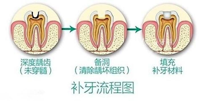 深圳醫(yī)院補(bǔ)牙多少錢(qián)一顆？