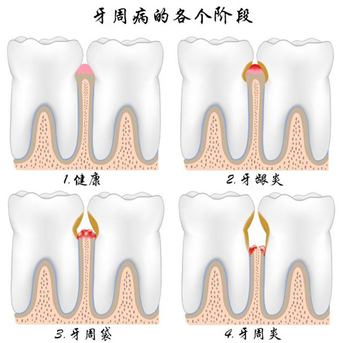 深圳孕婦牙周炎怎么辦？