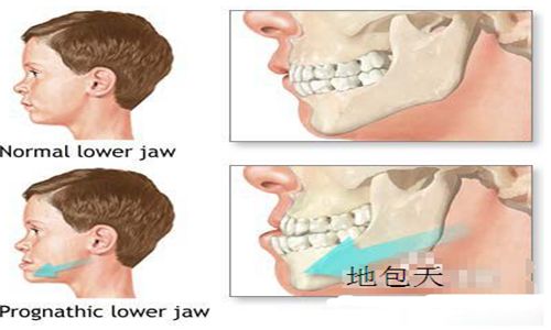 深圳兒童地包天如何治療？