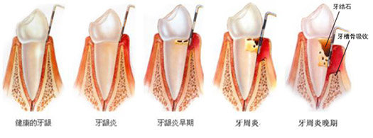 深圳牙周炎癥狀有哪些？