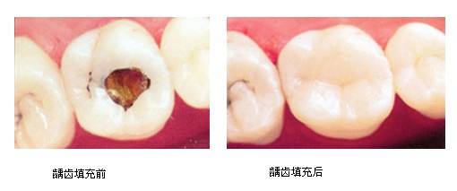 深圳齲齒牙洞填充要多少錢？