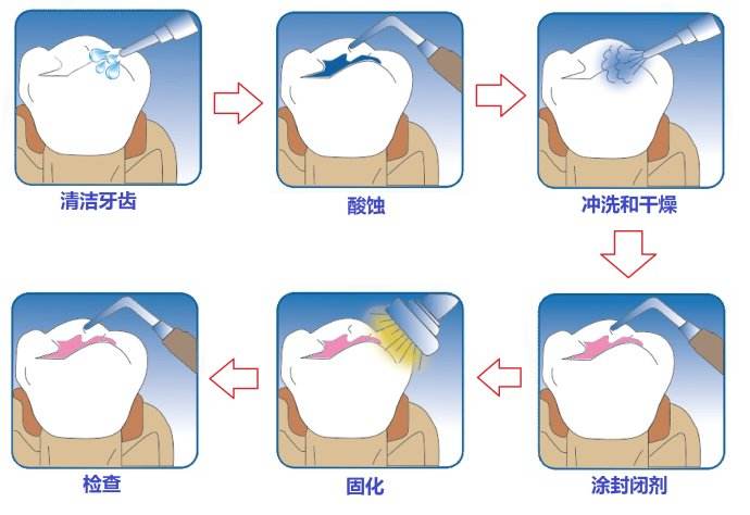 深圳怎么做窩溝封閉？