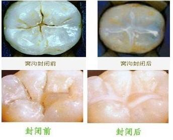 深圳牙齒窩溝封閉較佳時(shí)機(jī)