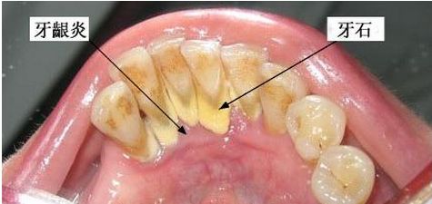 深圳為什么會(huì)形成牙結(jié)石？