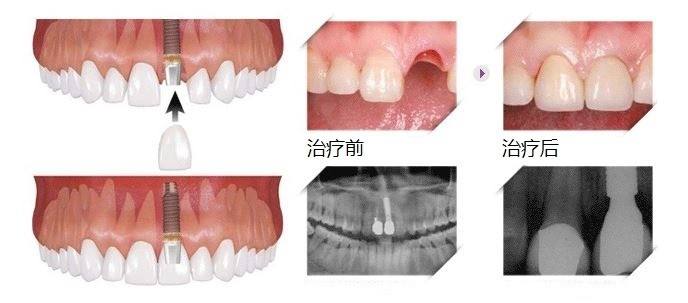 種一顆牙大概多少錢？