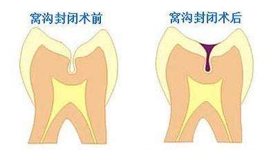 兒童窩溝封閉要不要做？