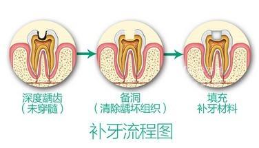 口腔醫(yī)院補牙要多久？