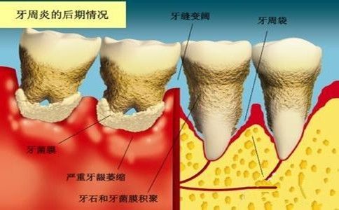 牙周炎需要拔牙嗎？