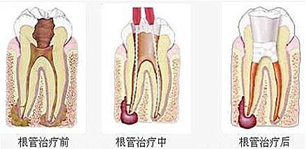 兒童牙齒根管治療需要多少錢(qián)？