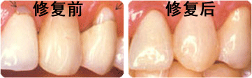 牙齒表面楔狀缺損應(yīng)該怎么辦？