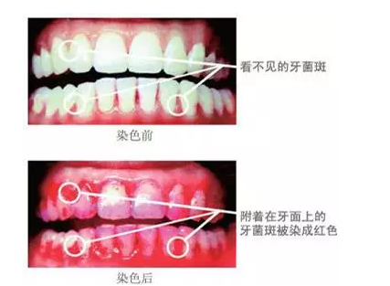 孩子牙齒上有牙菌斑怎么治療？