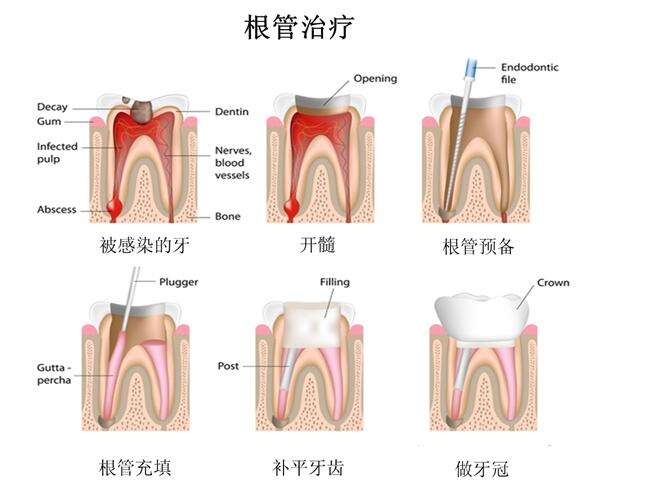 牙髓炎怎么辦？有哪些治療方法？