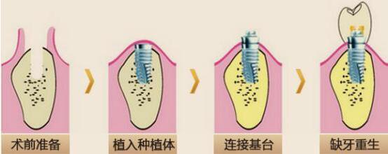 如何種植牙齒？種植牙過(guò)程是怎樣的？