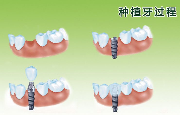 牙齒種植價(jià)格是多少？