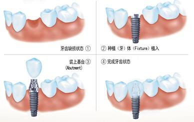 牙齒種植手術(shù)過程是怎樣的？