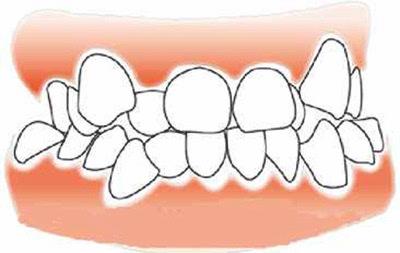 牙齒擁擠