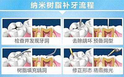 專業(yè)補(bǔ)牙過程是怎樣的？