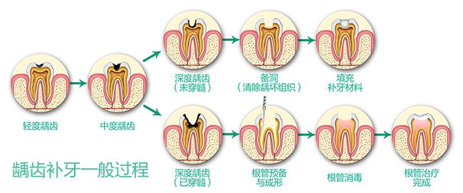 補牙一般需要多少錢？