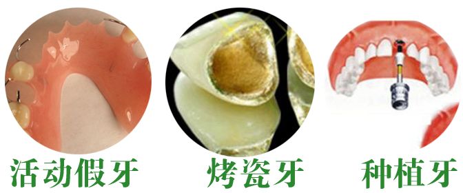 鑲牙門(mén)牙需要多少錢(qián)？