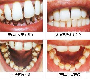 洗牙美白需要多少錢？