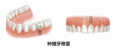 深圳鑲牙一般需要多少錢(qián)？