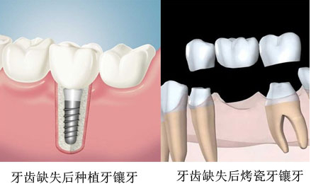 鑲牙多長時間可以完事？