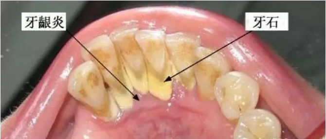 左氧氟沙星可以治療牙齦炎嗎？