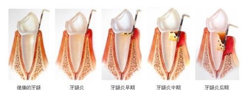 重度牙齦炎的癥狀有哪些？