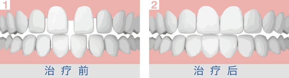 深圳牙齒稀疏牙縫大治療費用一般是多少？