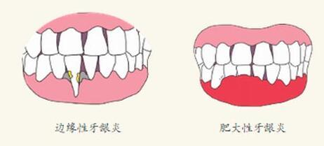 增生性牙齦炎的癥狀有哪些？