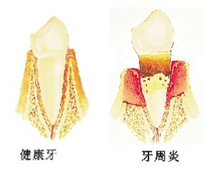 牙周炎與牙齦炎的區(qū)別有哪些？