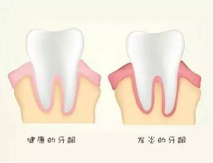 正常牙齦和牙齦炎的區(qū)別有哪些？